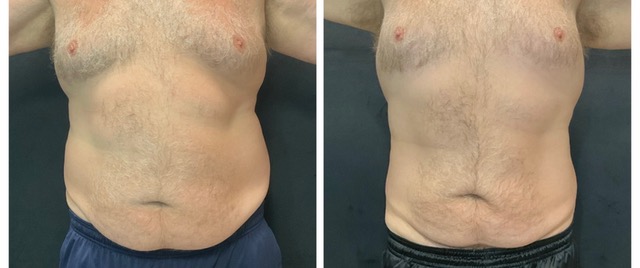 Red Light Therapy comparison 1, front view: before on the left and after on the right.