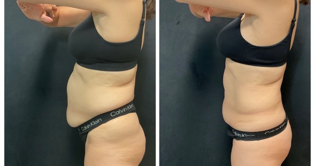 Red Light Therapy comparison 2, side view: before on the left and after on the right.
