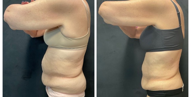 Red Light Therapy comparison 3, side view: before on the left and after on the right.