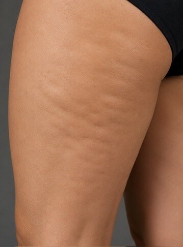 Before Red Light Therapy, cellulite