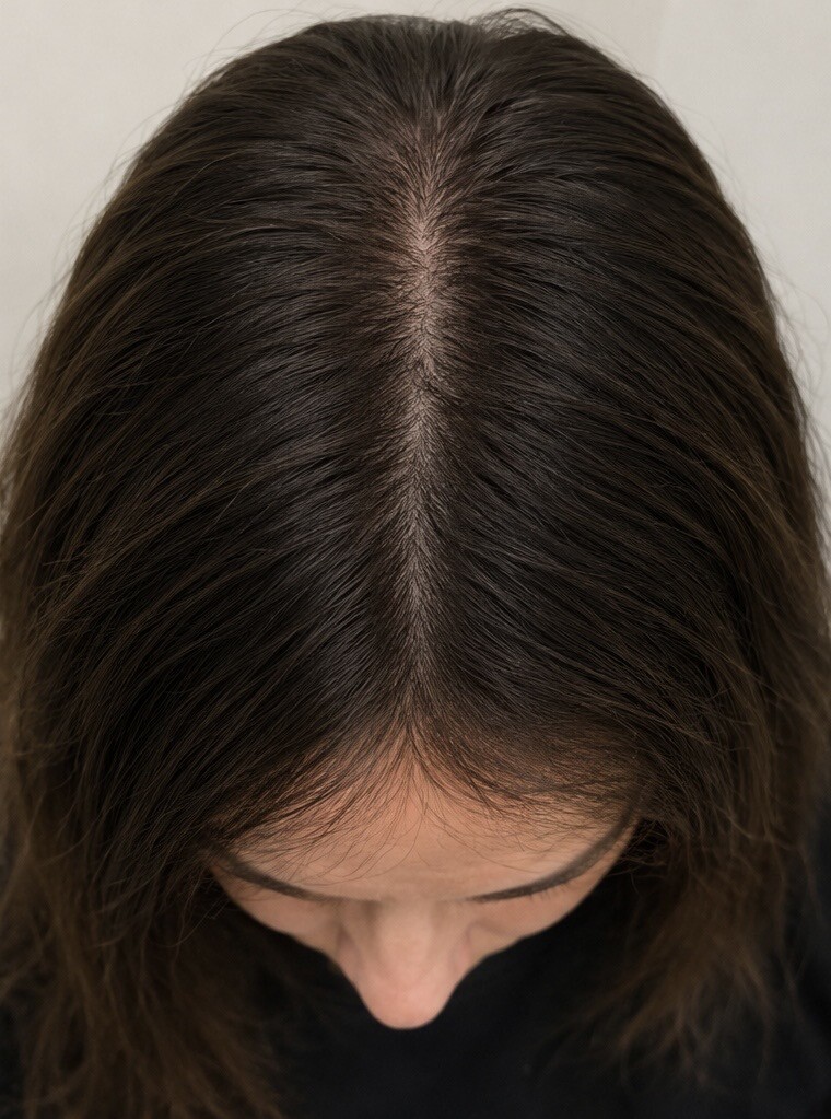 After Red Light Therapy, fuller, thicker hair