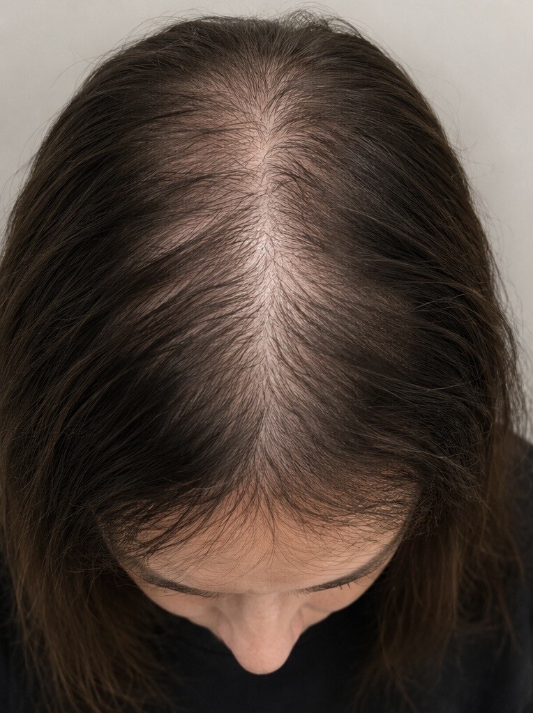 Before Red Light Therapy, thinning hair